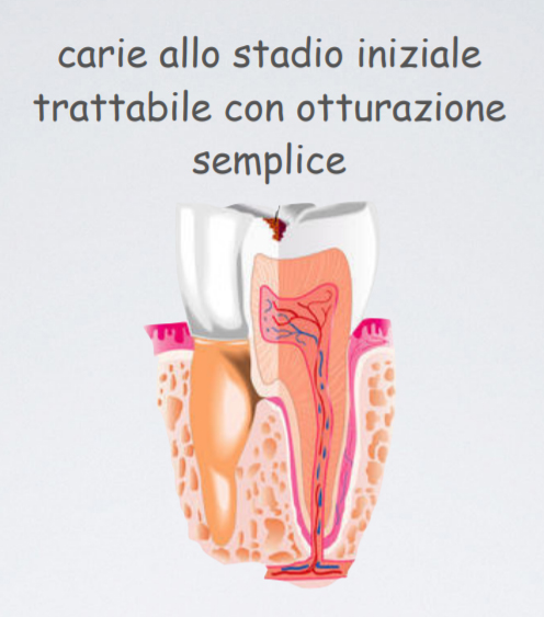 studio-dentistico-pagliani_cura-canalare_anatomia-dente-carie-06