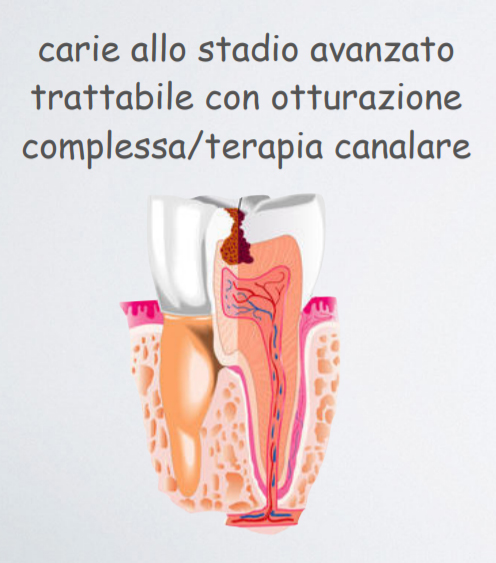studio-dentistico-pagliani_cura-canalare_anatomia-dente-carie-07
