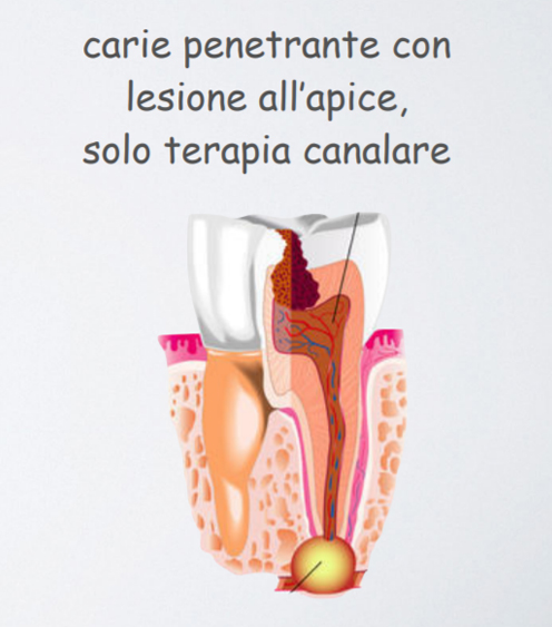 studio-dentistico-pagliani_cura-canalare_anatomia-dente-carie-08