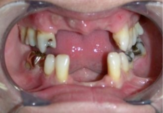 studio-dentistico-pagliani_protesi_12